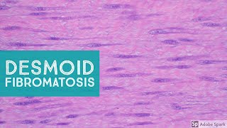 Desmoid Fibromatosis Desmoid Tumor  Explained by a Soft Tissue Pathologist [upl. by Basset802]