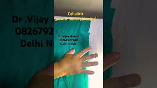 cellulitis post iv Thrombophlebitis surgery neet yt shorts cellulitis ssi skincare [upl. by Uase]