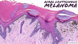 Acral Lentiginous Melanoma Dermatopathology [upl. by Alverta]