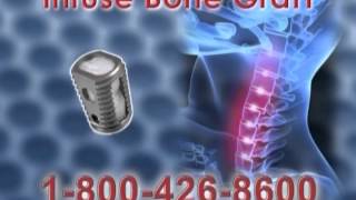 Neck Fusion Tort Lawyers TV Ad [upl. by Aelc]