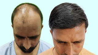 Best Hair Transplant Results with 4800 Grafts for Grade 6 Baldness  Hair Transplant in Raipur [upl. by Alleon134]