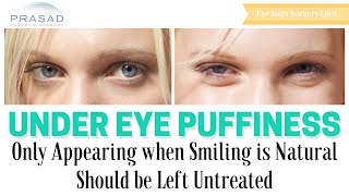 Puffiness Under Eyes that Only Appears When Smiling Does Not Need Cosmetic Treatment [upl. by Reina]