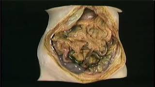 ANATOMIE FMPM CAVITÉ ABDOMINALE DISSECTION [upl. by Alleroif]