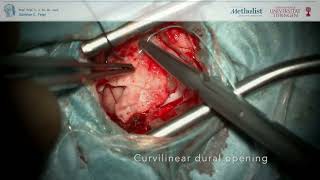 Microvascular Decompression for Hemifacial Spasm Minimally Invasive Surgery [upl. by Sergias]