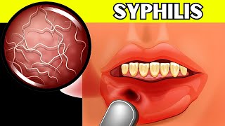 Syphilis  Causes Signs amp Symptoms Pathogenesis Diagnosis And Treatment [upl. by Nnaaihtnyc910]