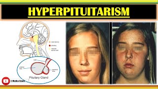 HYPERPITUITARISM  SIGN AND SYMPTOMS OF HYPERPITUITARISM  ETIOLOGY OF HYPERPITUITARISM  MANAGEMENT [upl. by Ibbed588]