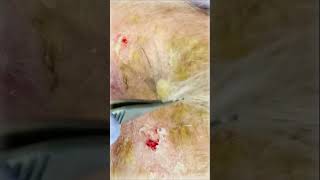 Erosive Pustulosis of the Scalp  Pimple Popping shorts [upl. by Tybi981]