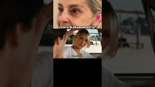 Com Blefaroplastia X Sem Blefaroplastia [upl. by Waugh]