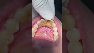 Teeth mobility dentistteeth dentist dentaltreatment [upl. by Chadbourne]