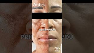 Existe remédio para melasma [upl. by Seidler]