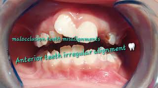 Mixed dentition stage variations congenital missing upper left lateral incisor improper alignments [upl. by Diskson]