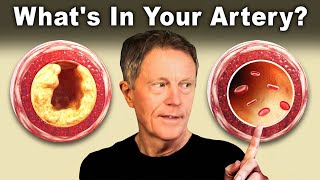 1 Best AT HOME Test to Find Clogged Arteries [upl. by Carlynn752]