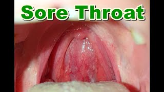 Normal vs Sore Throat  Pharyngitis [upl. by Kaz461]