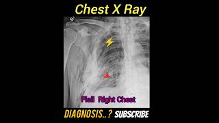 Flail chest  Diagnosis  CXR PA Practical case  Radiology [upl. by Hun]