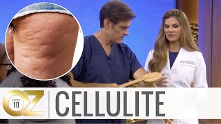 3 AtHome Cellulite Treatments [upl. by Anni]