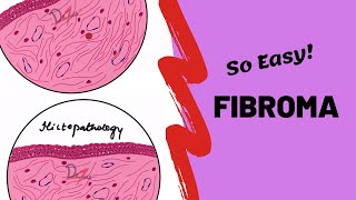 Fibroma  ORAL PATHOLOGY [upl. by Jacquet]