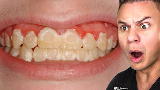 All Your Braces Pain In One Video [upl. by Eladnar]