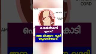 Cord around th fetal neck pregnancy malayalam trending cord pregnancycare [upl. by Walburga]