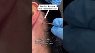 Skin Tag Removal With Radiofrequency  Quick amp Safe Treatment DRMEDISPA [upl. by Aidas]