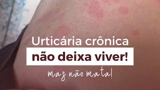 Urticária crônica não deixa a pessoa viver… [upl. by Hanoy]