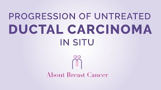 Management and Treatment of Ductal Carcinoma in Situ DCIS [upl. by Araccat]