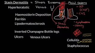 Stasis Dermatitis Part 2 [upl. by Nilpik]