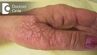 What is Neurodermatitis and how is it treated  Dr Tina Ramachander [upl. by Attenhoj]