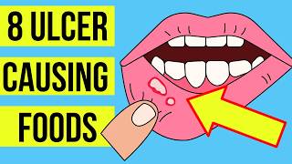 8 FOODS and DRINKS causing MOUTH ULCERS Canker sore  Plus treatment [upl. by Feil69]