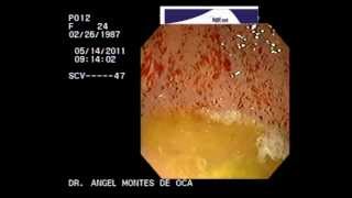 ENDOSCOPIA GASTRITIS EROSIVA NGELMED [upl. by Mavis787]