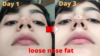 Reshape nose  Get rid of excess fat on nose tip and nostrils and get perfect nose reshapenose [upl. by Nyleak]