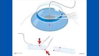 Corneal Suturing Part 2  Placing the Needle Into the Graft [upl. by Ynohtnad]