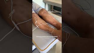 Electro acupuncture treatment for Parkinsons disease parkinsons [upl. by Aloiv]