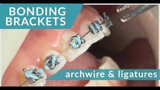 BRACES 🦷  BONDING🔎👄 archwires amp elastics [upl. by Aohk]