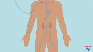 Traitement des varicocèles par embolisation  Chirurgie vasculaire miniinvasive [upl. by Pengelly574]