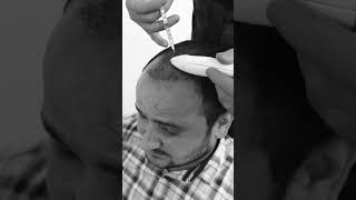 the ultimate solution for hair regrowth  Dadu medical centre [upl. by Kaltman]