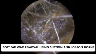 SOFT EAR WAX REMOVAL USING SUCTION AND JOBSON HORNE  Ep 31 [upl. by Euqirrne]