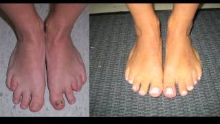 Limb Lengthening and Toe Lengthening with Dr Rozbruch Susans Story [upl. by Schiff657]