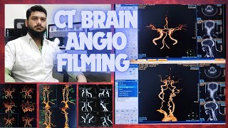 CT SCAN BRAIN ANGIOGRAPHY FILMING PROCESS ON PHILIPS INGENUITY MACHINE SOFTWARE  Circle of willis [upl. by Raddy937]