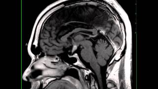 Hypothalamic Glioma in Neurofibromatosis Type I [upl. by Ahsienal]