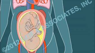 Amniotic Fluid Embolism AFE [upl. by Ladnar]