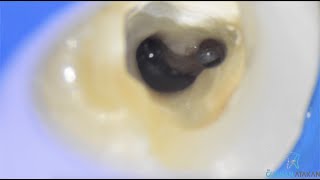 CShaped Root Canal Morphology  Vertical Hot GuttaPercha Obturation [upl. by Leverett]