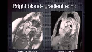 Cardiac MRI Pulse sequences [upl. by Aizti]