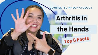 Arthritis in the HandsTop 5 Facts to know when you have hand arthritis [upl. by Tijnar]