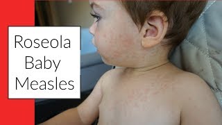 ROSEOLA  BABY MEASLES  SIGNS amp SYMPTOMS  RASH [upl. by Assiren]