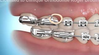 EOMAC FORMATION ORTHODONTIE La fabrication des gouttières [upl. by Gerdi]