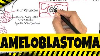 Ameloblastoma  Origination Clinical Radiographic amp Histopathologic features [upl. by Betz]