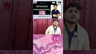 Ameloblastoma  Human Pathology  Full video available in the channel dental [upl. by Ecnerolf823]