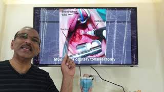 Techniques of tonsillectomy  HINDI Patient teaching programme [upl. by Joanie]