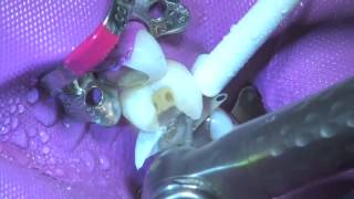 Tips on Avoiding Abrading Adjacent Teeth in a Class II Restoration Palodent® Plus  Dentsply Sirona [upl. by Necila231]