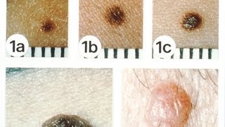 NonMelanoma Skin Cancers  Skin Cancer [upl. by Okir887]